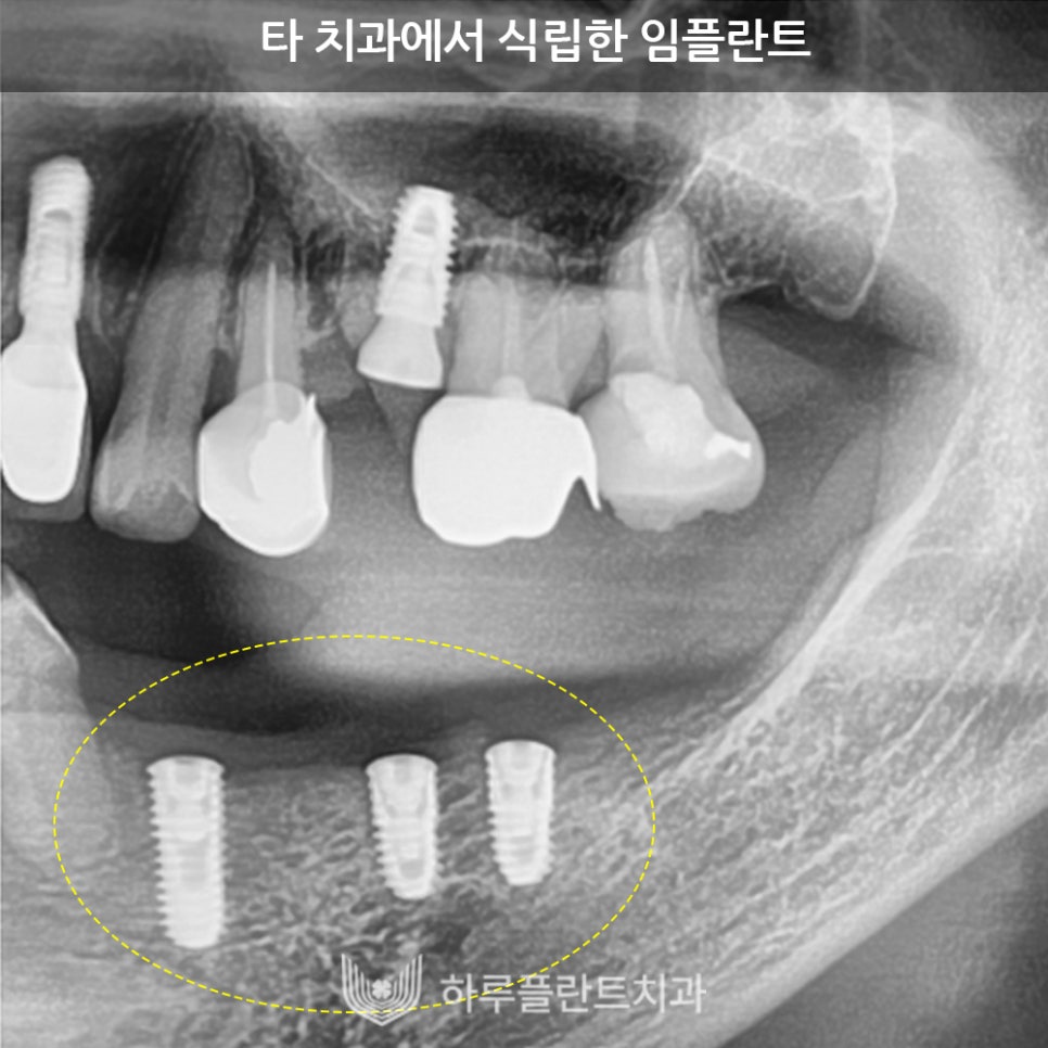강남역치과 하루플란트치과 임플란트 주위염 원인부터 예방법까지 관련 이미지 5