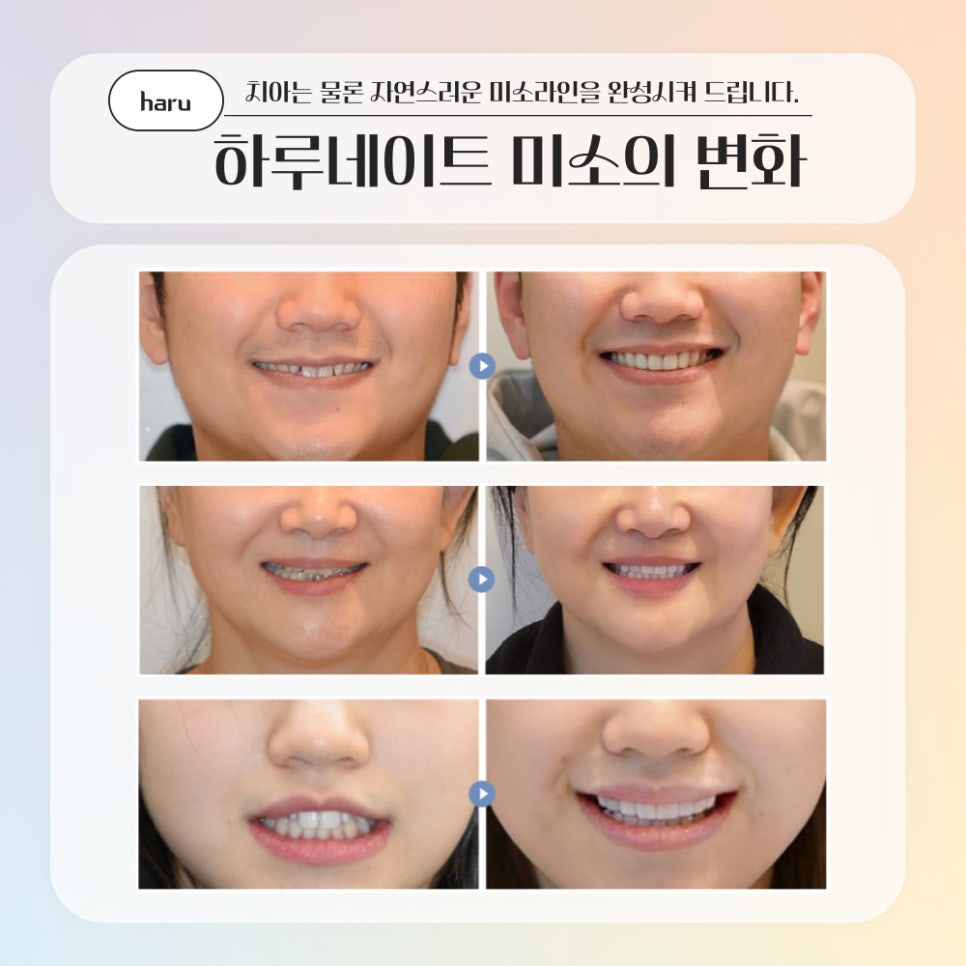 강남역치과 무삭제 라미네이트 총정리(부작용,치료기간,비용) - 하루플란트치과 관련 이미지 9