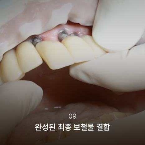 Why the Implant Impression Process Has Changed: The Full Implant Treatment Process at Haru Implant Dental Clinic at Gangnam Station That Makes a Difference in Results image 10