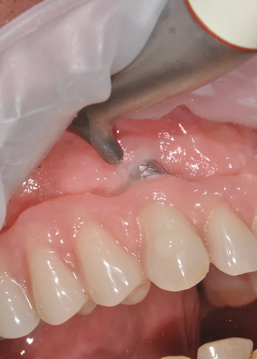 강남역스케일링 통증,시림 없는 프리미엄 에어플로우 스케일링 관련 이미지 16