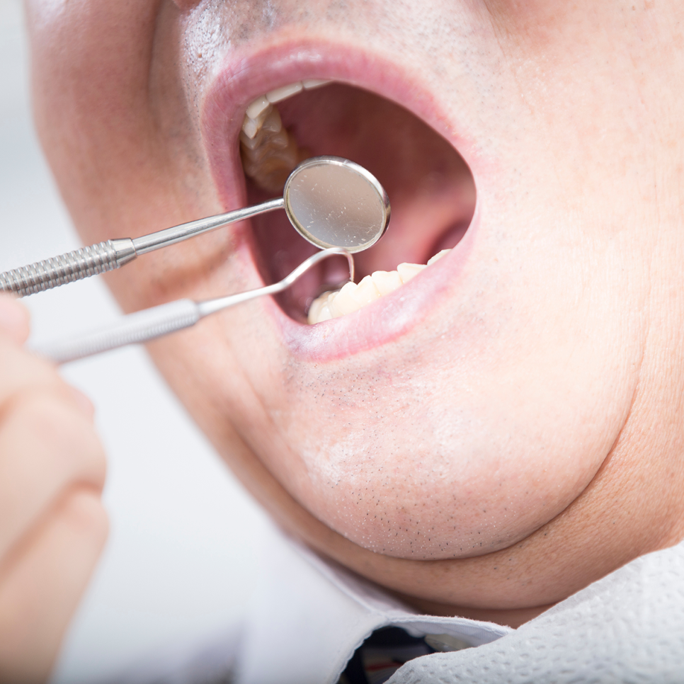 하루플란트가 알려주는 임플란트 후 음주! 술은 언제부터 마셔도 될까요? 관련 이미지 4