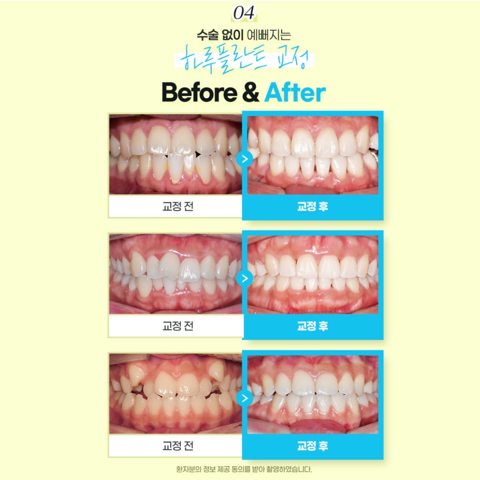 하루플란트치과 여름방학맞이 치아교정 이벤트! 관련 이미지 5