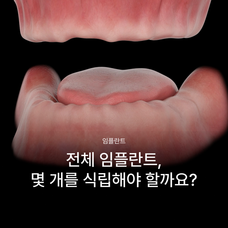 How Many Implants Are Needed for Full-Mouth Implant Treatment? The Type and Cost of Full-Arch Implants Vary Depending on the Number That Suits You image 1