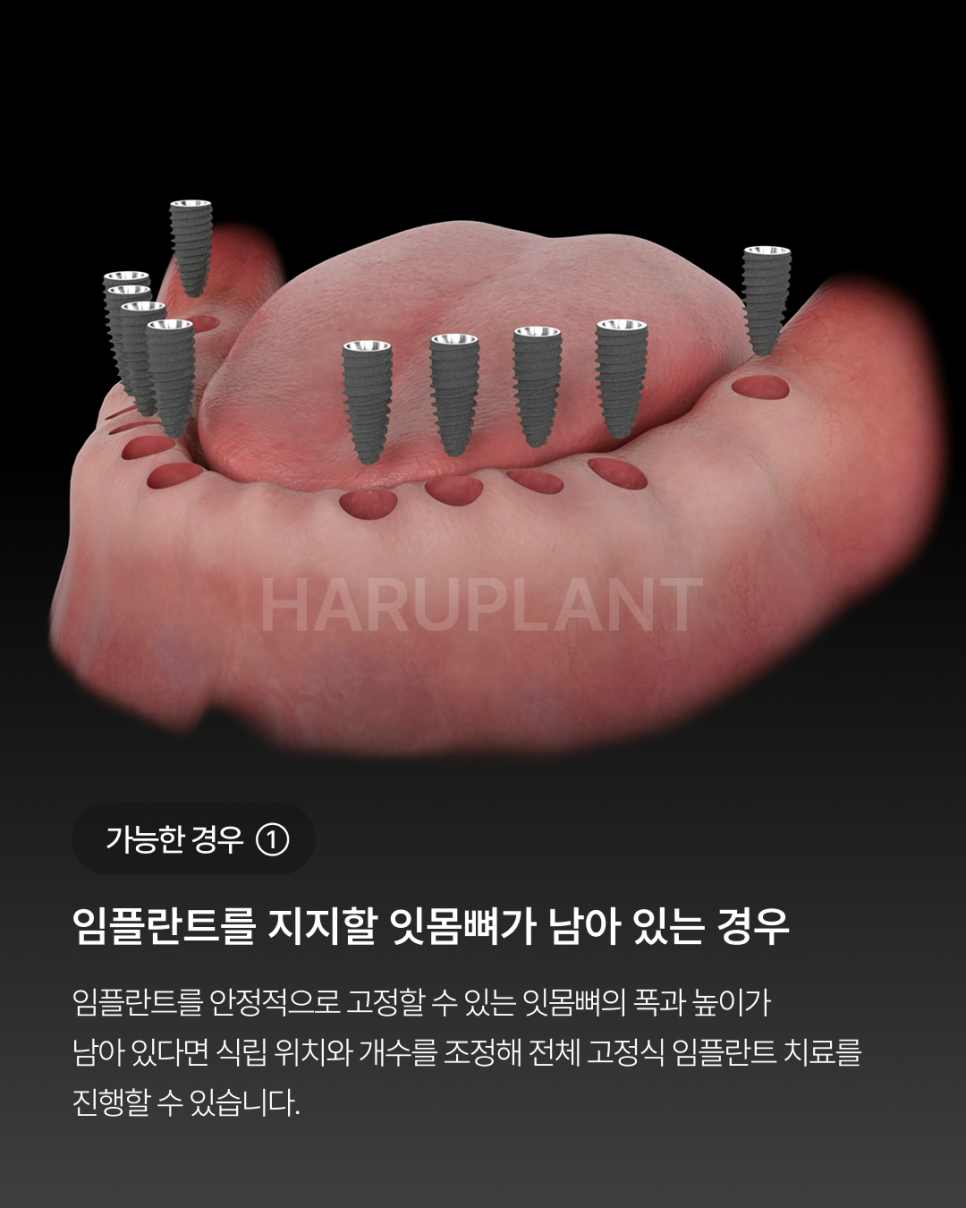 오랜 틀니 사용 후 전체 임플란트가 가능한 경우, 임플란트 종류와 전체 임플란트 뜻까지 관련 이미지 3