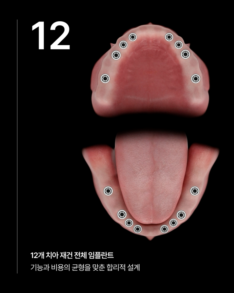 How Many Implants Are Needed for Full-Mouth Implant Treatment? The Type and Cost of Full-Arch Implants Vary Depending on the Number That Suits You image 3
