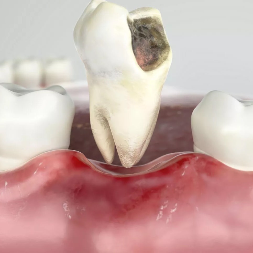 임플란트 걱정하는 당뇨 환자라면? OOOO 임플란트가 답이다! 관련 이미지 2