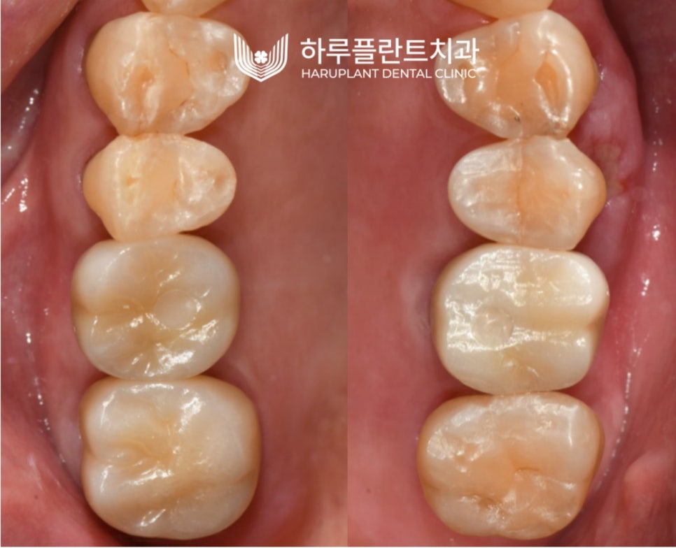 강남역 하루플란트치과 임플란트 무절개 상악동 거상술 진행 케이스 관련 이미지 11
