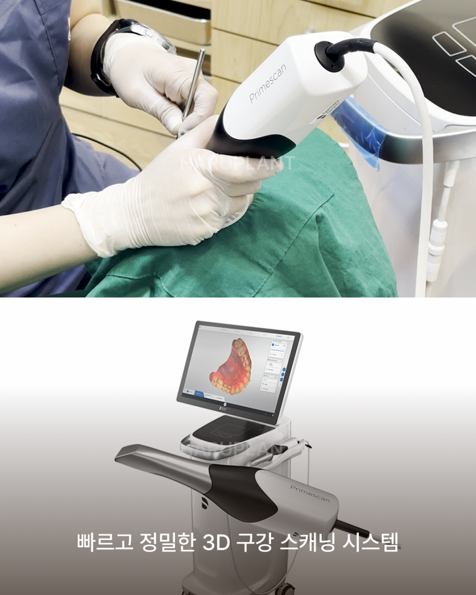 How Many Implants Are Needed for Full-Mouth Implant Treatment? The Type and Cost of Full-Arch Implants Vary Depending on the Number That Suits You image 9