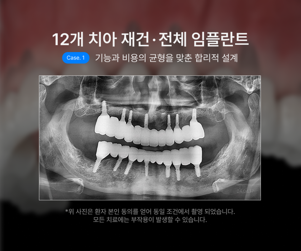How Many Implants Are Needed for Full-Mouth Implant Treatment? The Type and Cost of Full-Arch Implants Vary Depending on the Number That Suits You image 6
