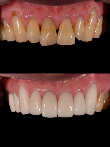 치아 사이 틈, 하루네이트로 해결할 수 있습니다 관련 이미지 9