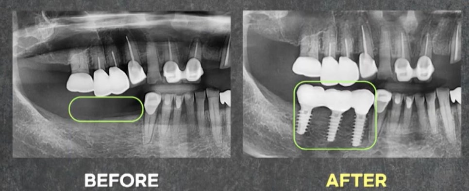 임플란트 전문가 변성만 원장 TV 출연 - 통증 줄인 무절개 임플란트 관련 이미지 16