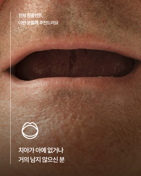 65세이상임플란트 중 무치악에 해당한다면, 전체임플란트가 필요한지 먼저 확인하세요! 관련 이미지 2