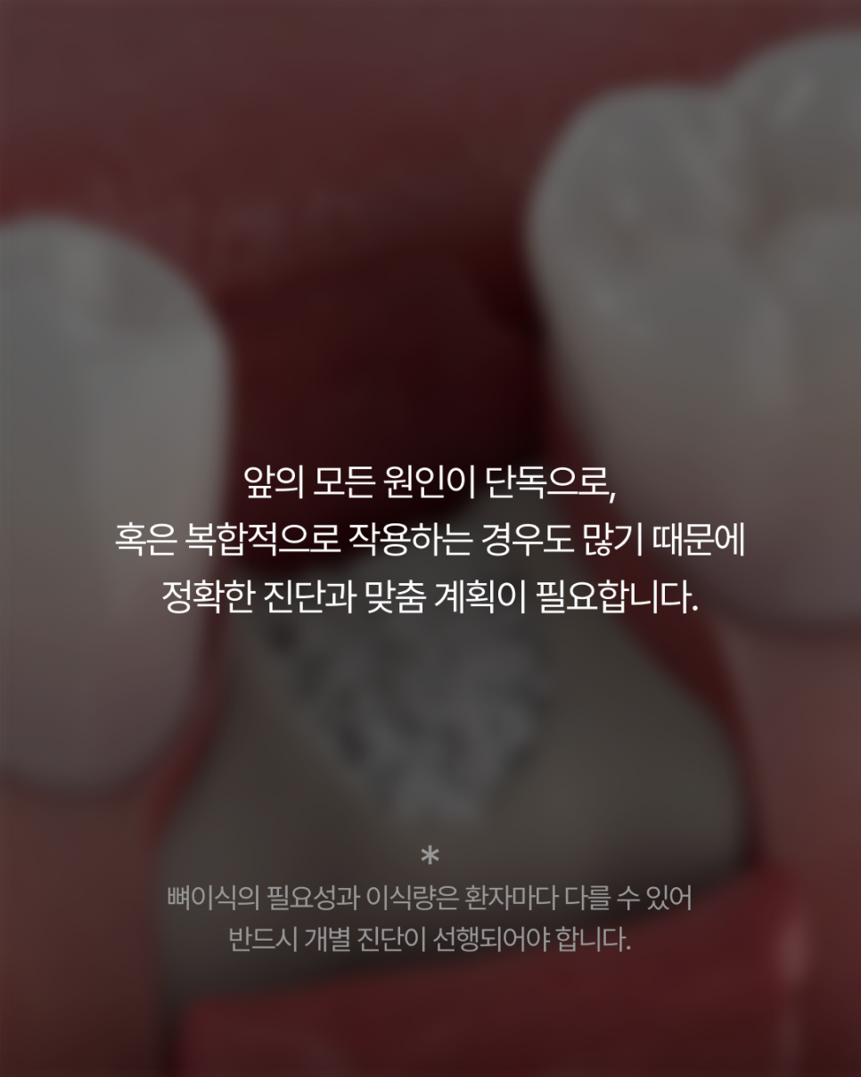 임플란트뼈이식, 반드시 필요할까요? 강남임플란트 하루플란트에서 기준을 확인하세요 관련 이미지 9