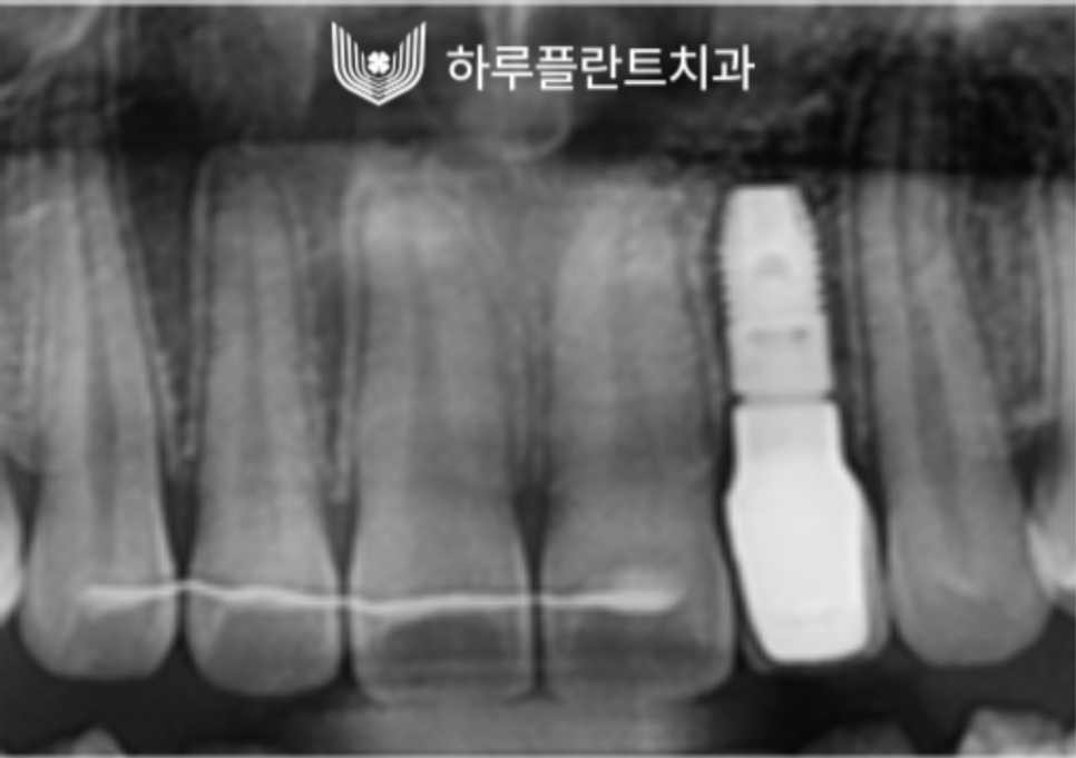 강남역 하루플란트치과 앞니 임플란트 후기 전후차이 관련 이미지 9