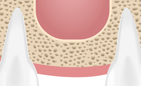 임플란트 뼈이식 수술 후기와 진행과정 공개 관련 이미지 8