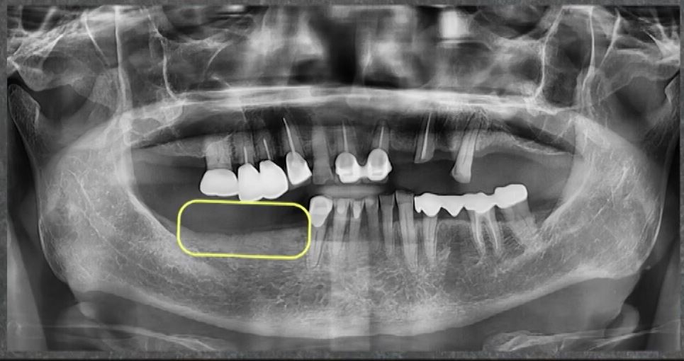임플란트 전문가 변성만 원장 TV 출연 - 통증 줄인 무절개 임플란트 관련 이미지 3