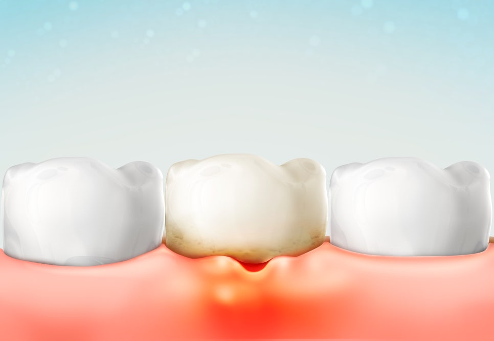 [하루플란트치과] 치과의사 김형규 원장과 함께하는 치아건강관리 꿀팁! 관련 이미지 3