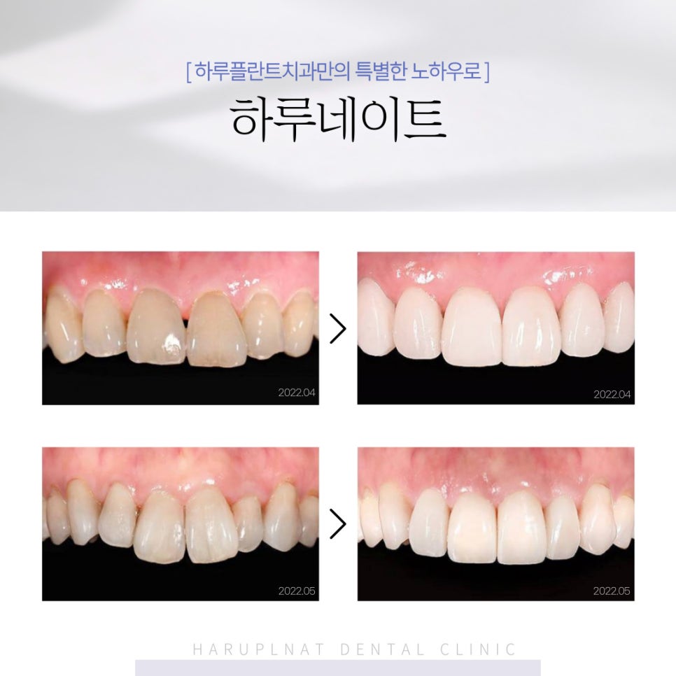 강남 하루플란트치과 라미네이트, 치아 삭제가 걱정된다면 관련 이미지 5