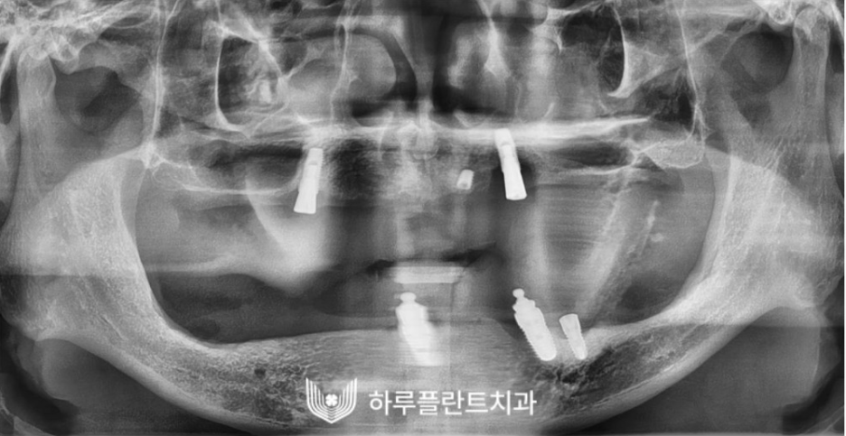 하루플란트치과 변성만 대표원장 타치과 임플란트 불가판정 성공사례 관련 이미지 3