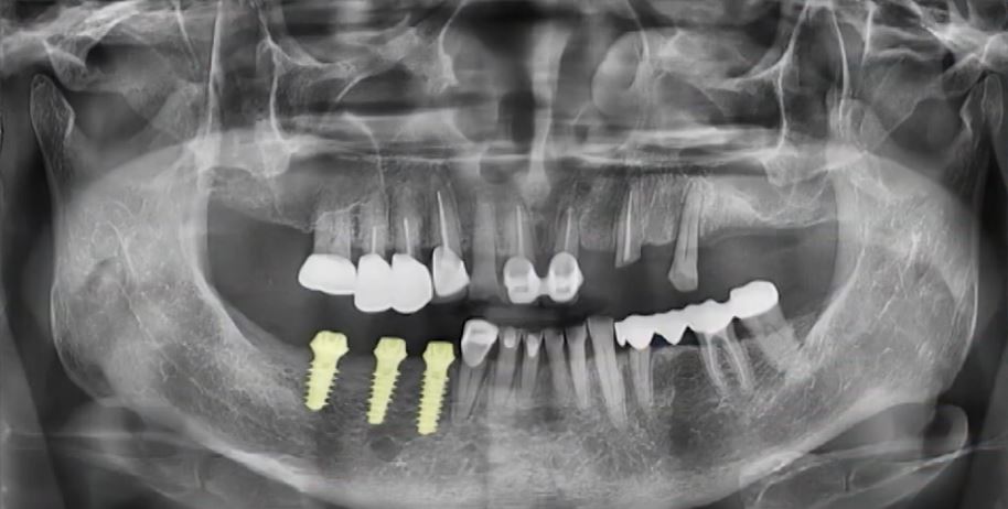 임플란트 전문가 변성만 원장 TV 출연 - 통증 줄인 무절개 임플란트 관련 이미지 13