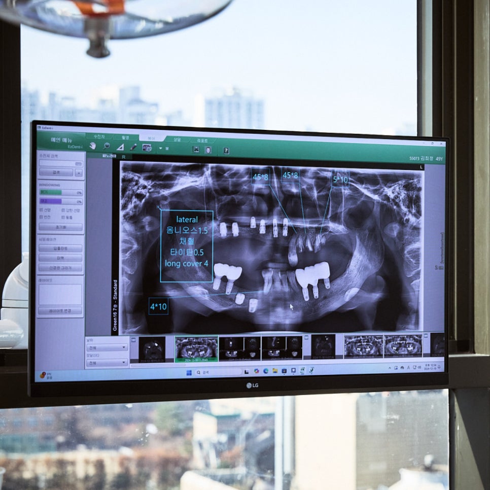 임플란트 이물감, 원인은 미세한 차이? 딱 맞는 보철물, 하루플란트에서 입 안 이물감 해결하기 관련 이미지 2