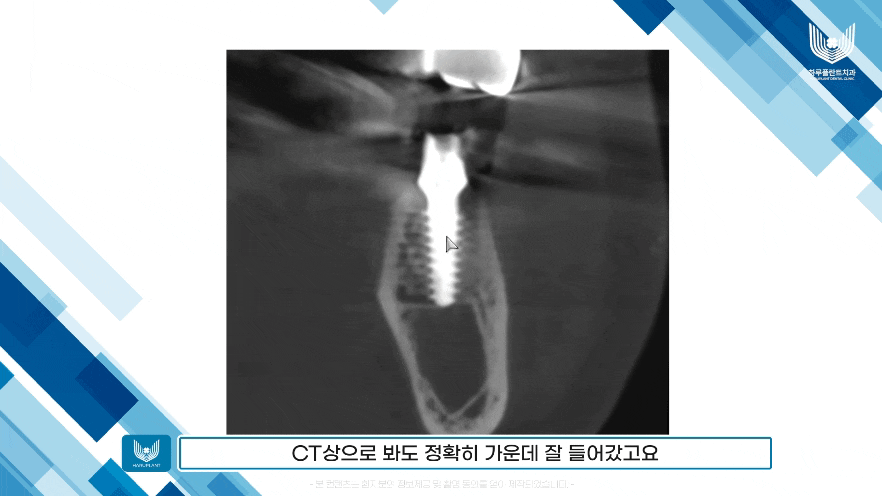 강남구 당일 임플란트 성공의 비결은? 관련 이미지 11