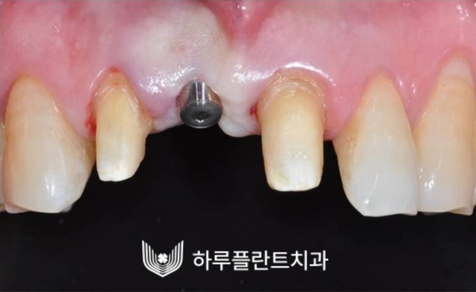 강남역 하루플란트치과 앞니 임플란트 후기 전후차이 관련 이미지 11