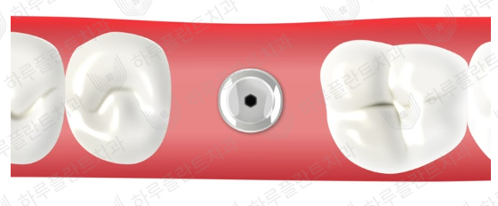 강남역 하루플란트치과 임플란트 무절개 상악동 거상술 진행 케이스 관련 이미지 5