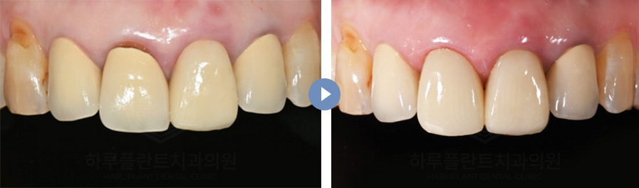 치과당일치료 하루플란트치과의 혁신적인 하루완성 클리닉 관련 이미지 13