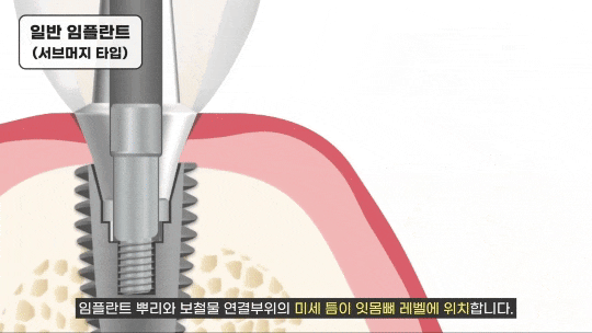 임플란트 평생 쓸 수 있나요? 오래 쓰는 방법 대공개(무절개 임플란트 수명) 관련 이미지 3