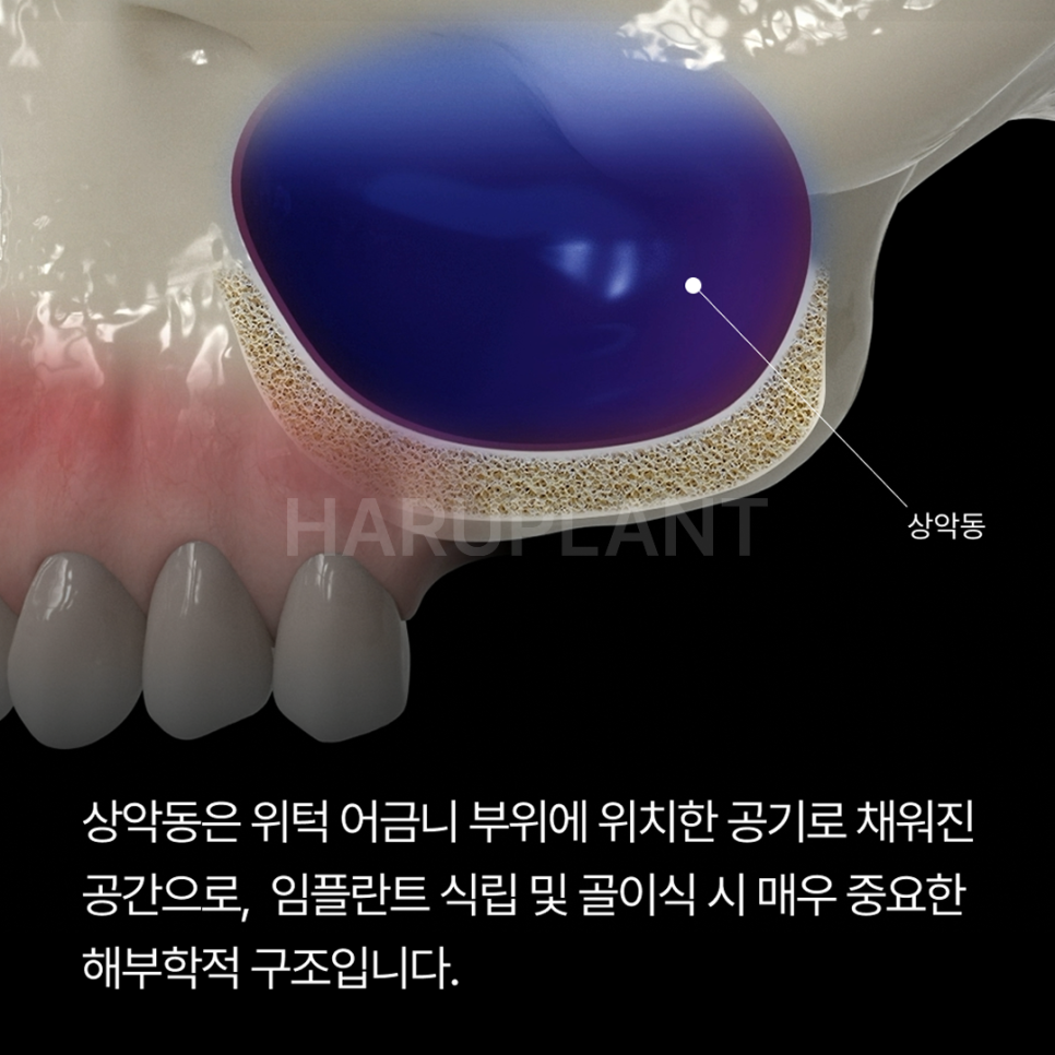 상악동거상술 뜻과 종류로 알아보는 위턱 어금니가 고난도임플란트가 되는 이유 관련 이미지 2