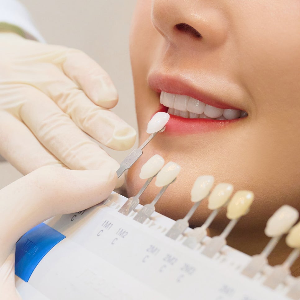 변색 치아, 단 하루면 충분하다? 하루플란트의 치아 미백 과정 전격 대공개! 관련 이미지 6