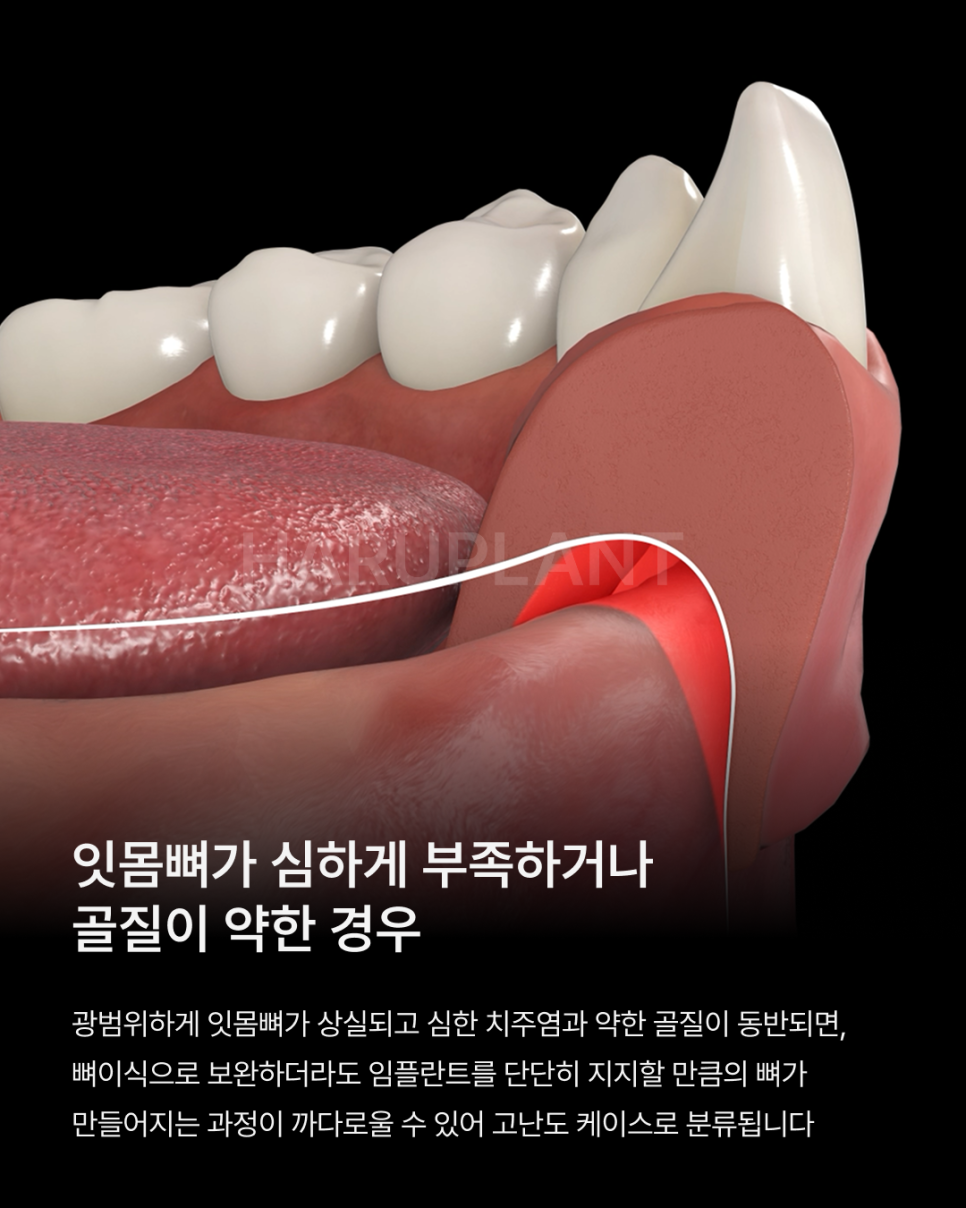 나도 고난도 임플란트 케이스일까? 상악동거상술부터 재수술까지 고난도임플란트종류 알아보기 관련 이미지 2
