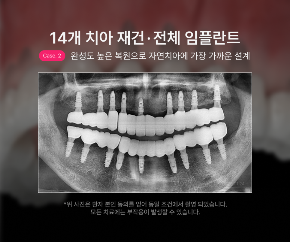 How Many Implants Are Needed for Full-Mouth Implant Treatment? The Type and Cost of Full-Arch Implants Vary Depending on the Number That Suits You image 8