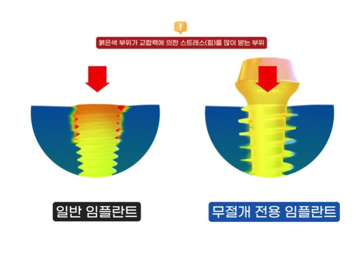 통증 줄이고 회복 빠른 하루플란트치과 CLS 무절개 임플란트 관련 이미지 5