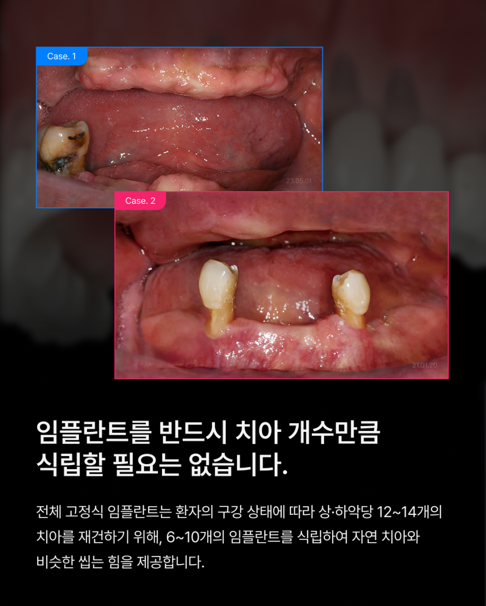 How Many Implants Are Needed for Full-Mouth Implant Treatment? The Type and Cost of Full-Arch Implants Vary Depending on the Number That Suits You image 2