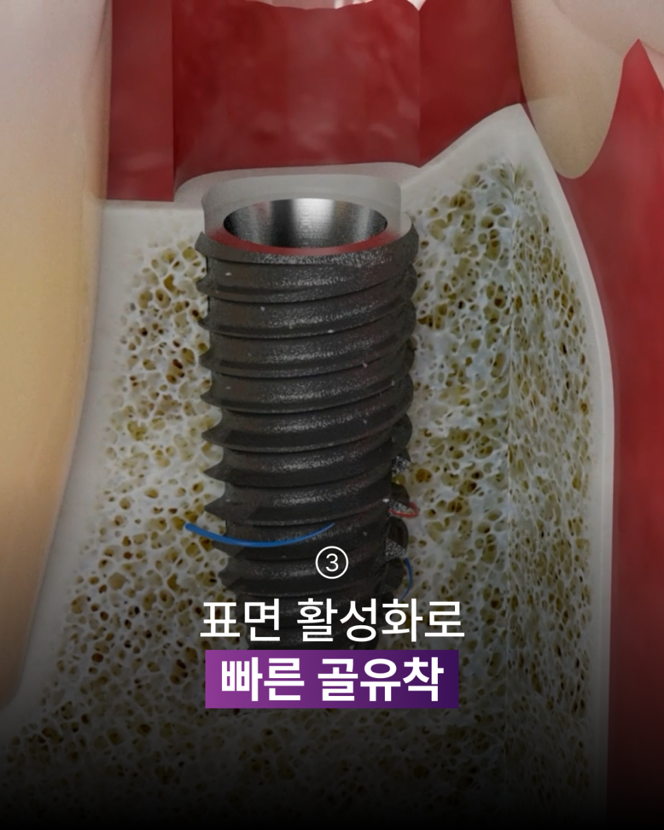 Why Do Implant Treatment Time and Implant Pain Vary? Recovery Standards Seen Through Plasma Implants image 4