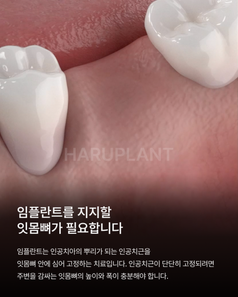 뼈이식임플란트 전 이런 점이 궁금하셨나요? 뼈이식임플란트과정과 기간, 통증까지 정리해드립니다 관련 이미지 2