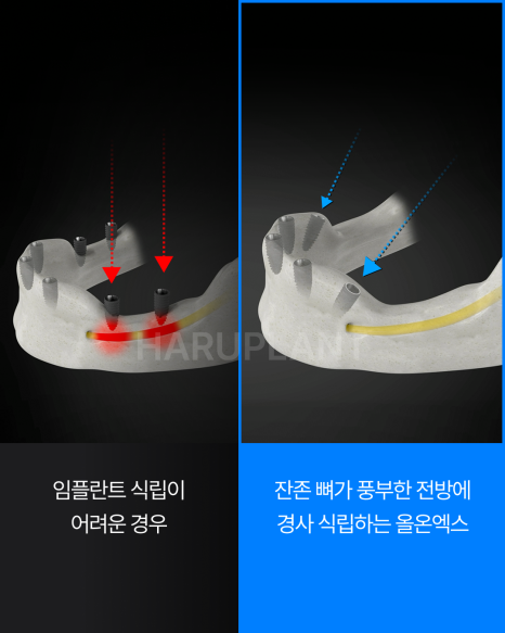 Why All-on-X Implants May Be Worth Considering Even If You Have Been Told That Full-Arch Implants Are Difficult image 8