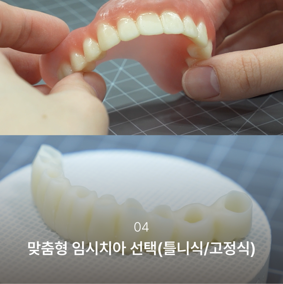 Why the Implant Impression Process Has Changed: The Full Implant Treatment Process at Haru Implant Dental Clinic at Gangnam Station That Makes a Difference in Results image 5