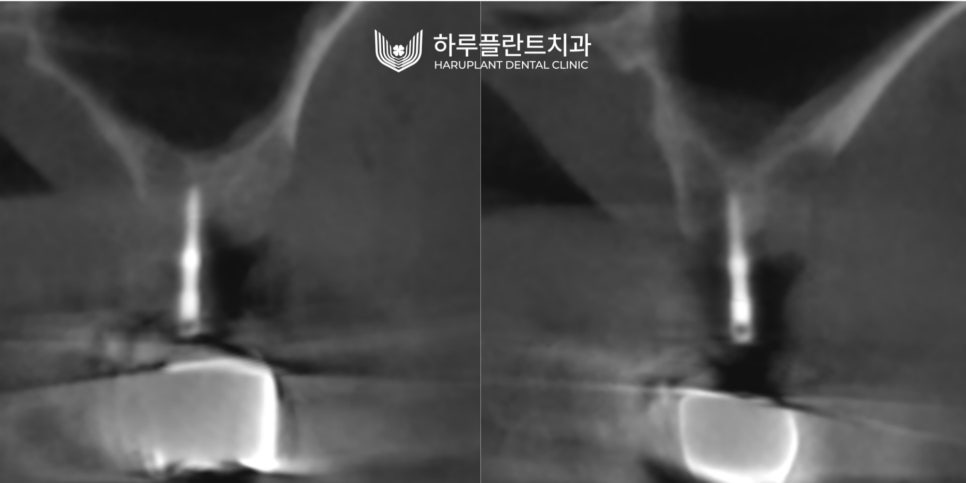 강남역 하루플란트치과 임플란트 무절개 상악동 거상술 진행 케이스 관련 이미지 8