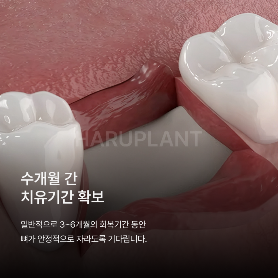 뼈이식임플란트 전 이런 점이 궁금하셨나요? 뼈이식임플란트과정과 기간, 통증까지 정리해드립니다 관련 이미지 7