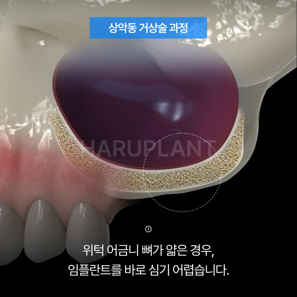 상악동거상술 뜻과 종류로 알아보는 위턱 어금니가 고난도임플란트가 되는 이유 관련 이미지 4