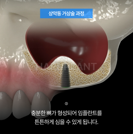 상악동거상술 뜻과 종류로 알아보는 위턱 어금니가 고난도임플란트가 되는 이유 관련 이미지 6