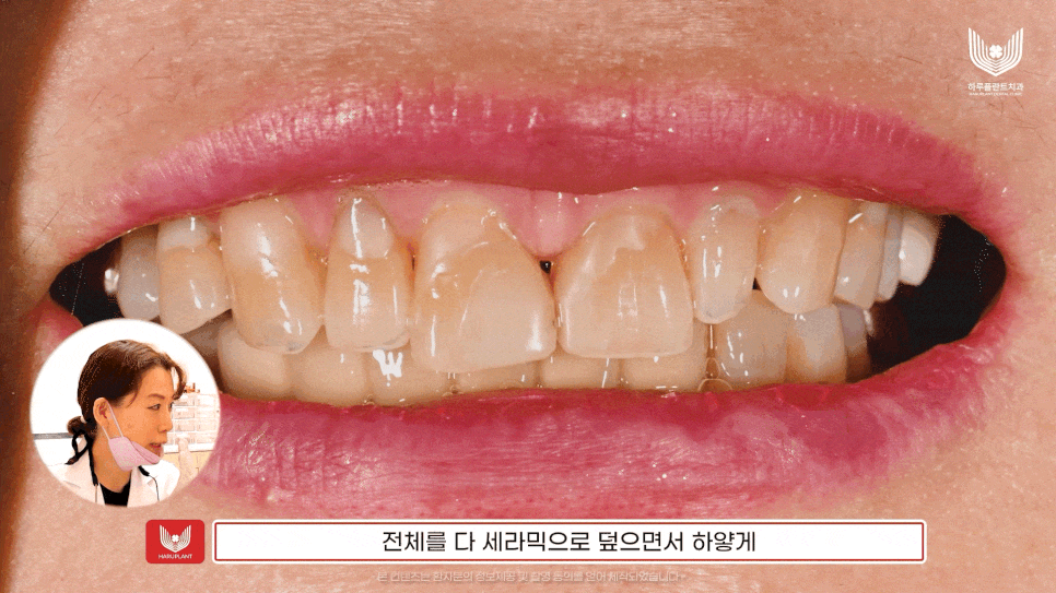 무삭제 라미네이트, 원데이 치료 관련 당부의 말씀 - 하루플란트치과 방문 전 필독 관련 이미지 2