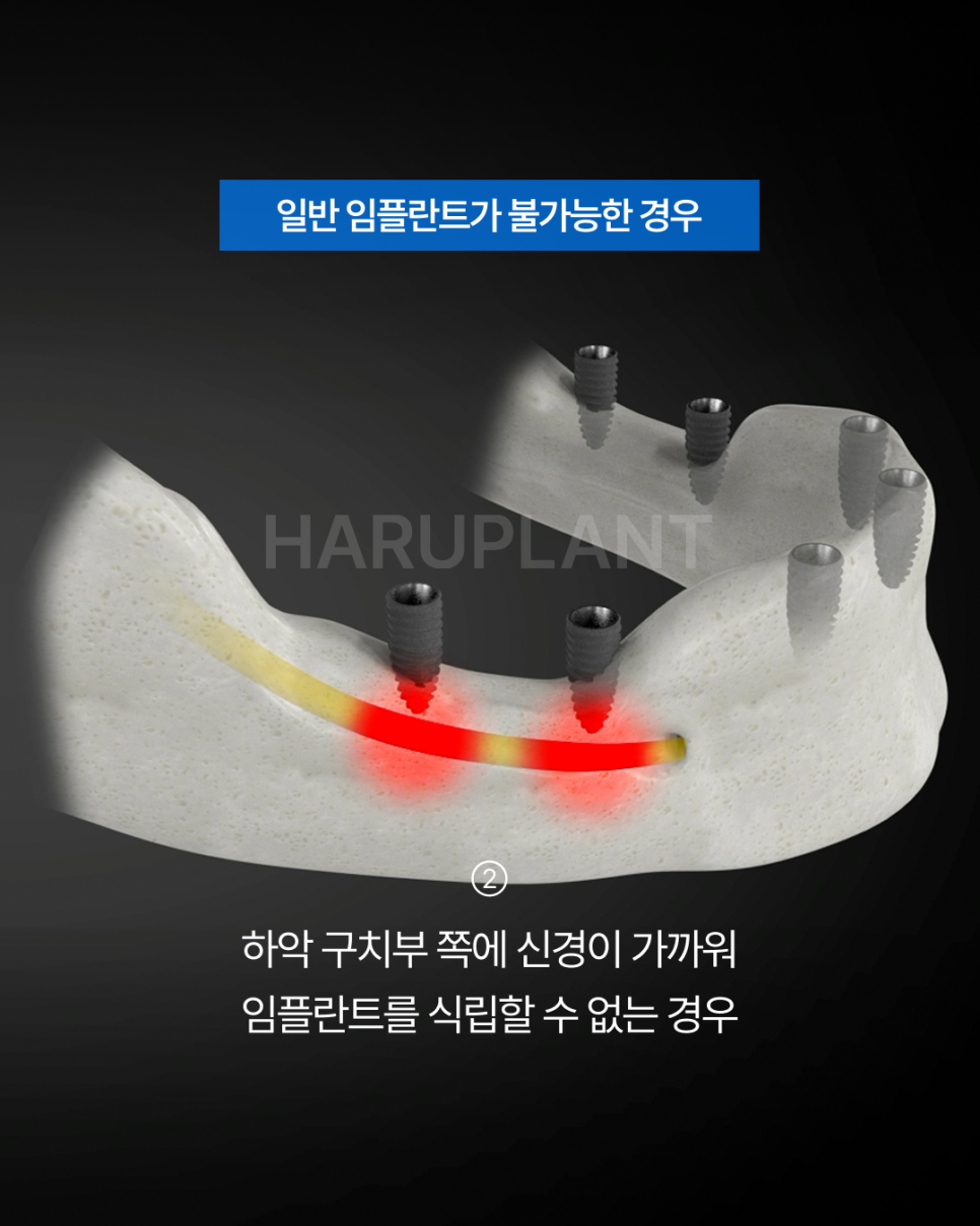 Why All-on-X Implants May Be Worth Considering Even If You Have Been Told That Full-Arch Implants Are Difficult image 4