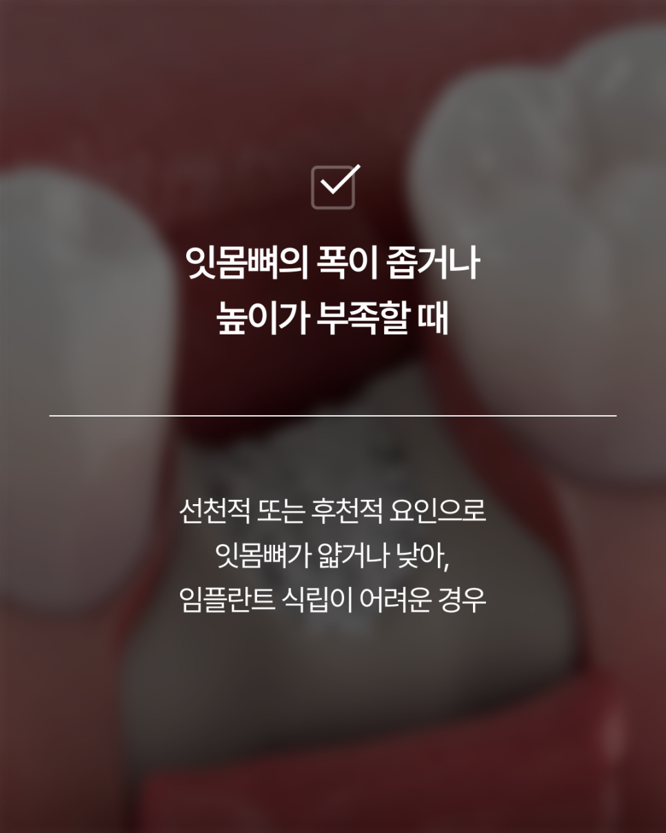 임플란트뼈이식, 반드시 필요할까요? 강남임플란트 하루플란트에서 기준을 확인하세요 관련 이미지 4