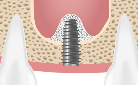 임플란트 뼈이식 수술 후기와 진행과정 공개 관련 이미지 9