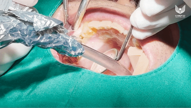 강남구 당일 임플란트 성공의 비결은? 관련 이미지 6