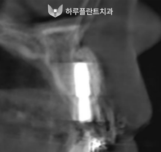 강남역 하루플란트치과 앞니 임플란트 후기 전후차이 관련 이미지 8